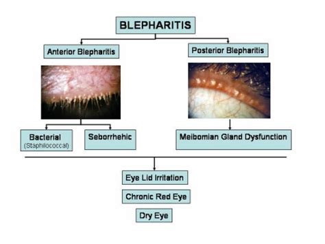 Blepharitis - IMU computer group 6 Treat the disease not the symptom