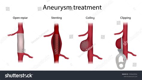 89 Aneurysm clipping Images, Stock Photos & Vectors | Shutterstock