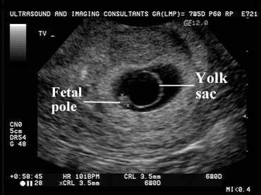 Abnormalities of the Yolk Sac | Diagnostic medical sonography, Medical ultrasound, Ultrasound ...