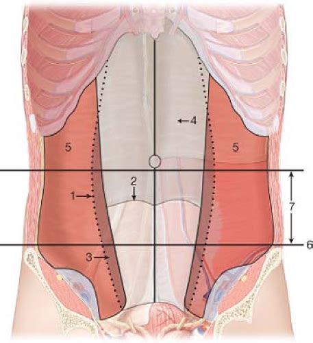 Spigelian Hernia | Abdominal Key