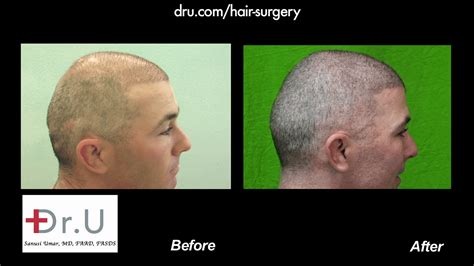 avaro Normalización Arado buzz cut balding before and after Enemistarse jugo Preparación