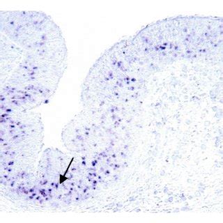 Mucin gene expression in laryngopharyngeal reflux mucosa. In situ ...