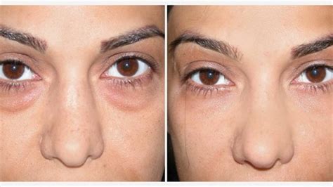 Everything You Need to Know About Under Eye Bags and Dark Circles ...