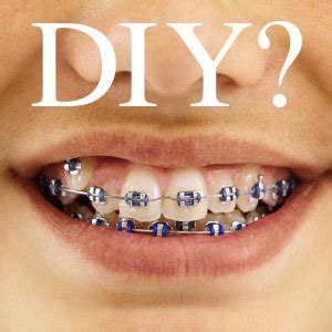 DIY Braces Can Ruin Your Child's Smile - Streamline For Kids