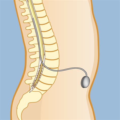 Pump: Baclofen Pump