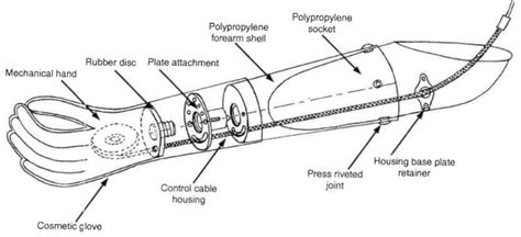 Left below-elbow prosthesis. | Download Scientific Diagram