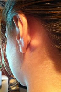 Lump Behind Ear: Pictures, Cyst Behind Ear Causes & Treatment