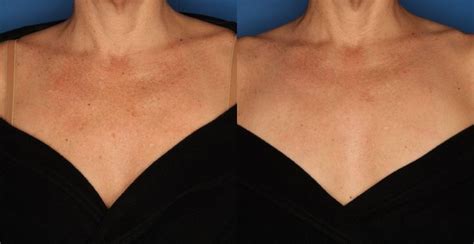 Before and After 3 sessions of IPL Photo rejuvenation to the neck & chest. | Laser hair removal ...