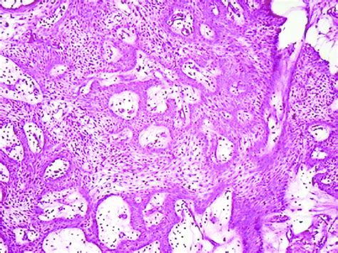 Ameloblastoma Histology