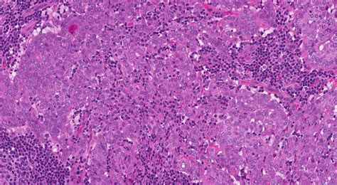 Acinic cell carcinoma of the salivary glands | Ottawa Atlas of Pathology