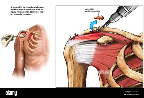 Acromioplasty - Shoulder Impingement Syndrome Surgery Stock Photo: 7710177 - Alamy