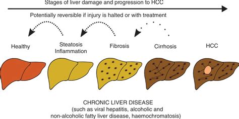 Liver Disease Progression