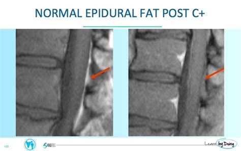 Epidural Infection: Why Fat is your friend - Radedasia