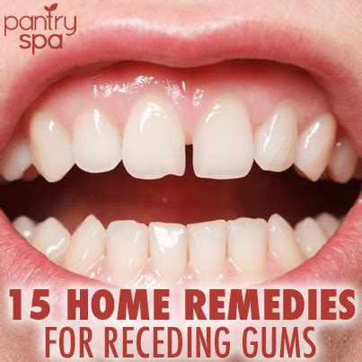 15 Home Remedies for Receding Gums (Natural DIY At Home Tips!)