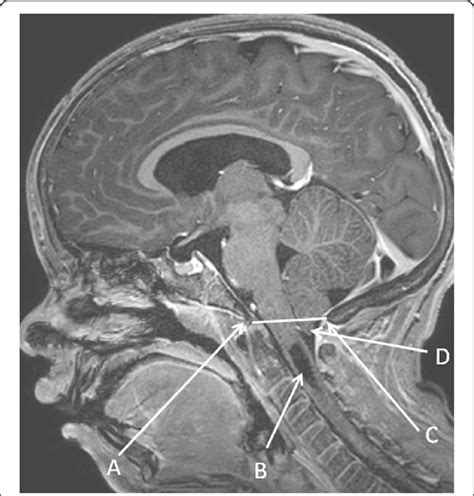 Cerebellar Tonsils Mri