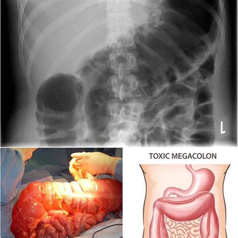 Toxic megacolon - MEDizzy