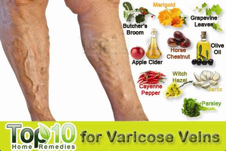 Home Remedies for Varicose Veins