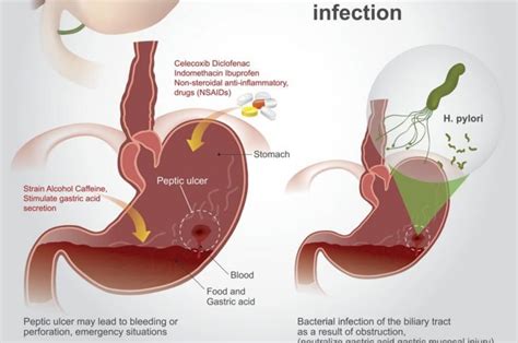 10 Causes of Hematochezia - Health & Detox & Vitamins