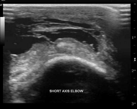 Olecranon bursitis | Radiology Reference Article | Radiopaedia.org