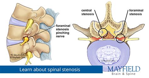 Spinal stenosis, diagnosis and treatments | Mayfield Brain & Spine ...