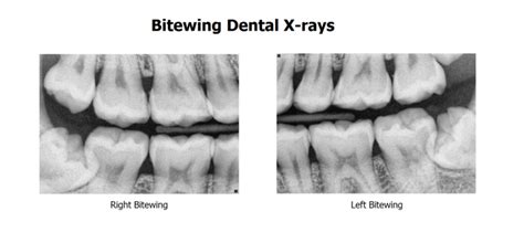 bitewings - Chicago Beautiful Smiles