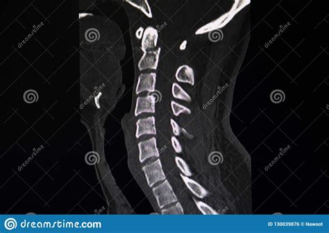 Fracture C2 Cervical Vertebrae. Stock Photo - Image of information ...