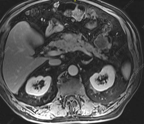 Pancreatitis, MRI - Stock Image - C039/3177 - Science Photo Library