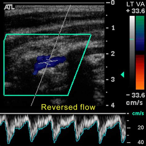 RadioGraphics: Sonographic Examination of the Carotid Arteries