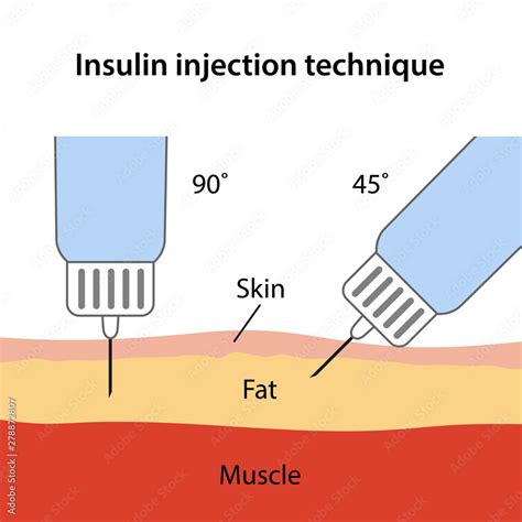 Insulin injection technique for diabetes depending on needle angle: 90 and 45 degrees ...