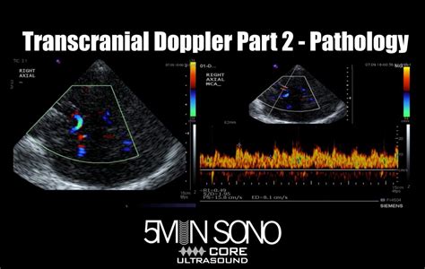 5 Minute Sono – Transcranial Doppler Part 2 – Pathology – Core Ultrasound