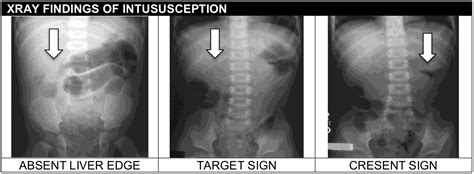 Intussusception – Core EM