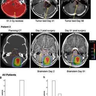 Patient 1: Treatment plan of a patient with medulloblastoma, boosted up... | Download Scientific ...