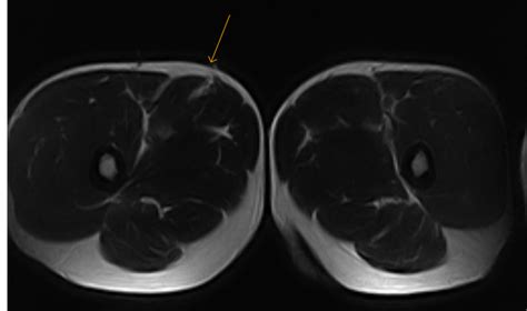 Adductor Strain-MRI - Sumer's Radiology Blog