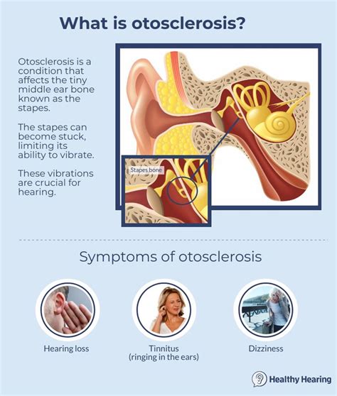 Otosclerosis | Hearing health, Hearing loss, Nursing school survival