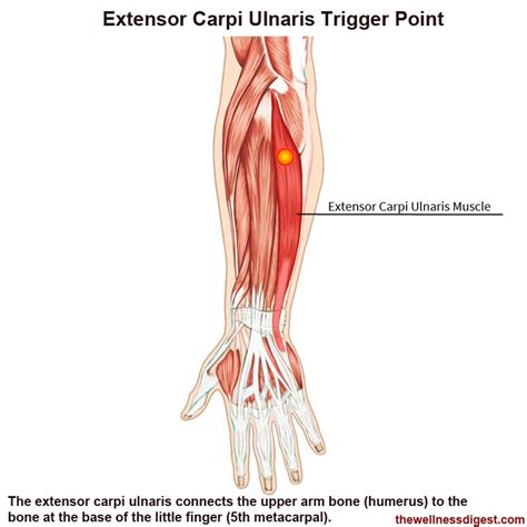 Extensor Carpi Ulnaris Muscle With Arm And Hand Wrist Bones Outline Diagram ...