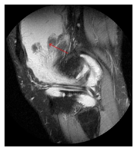 MRI of a 22-year-old male patient with lipoma arborescens of knee... | Download Scientific Diagram