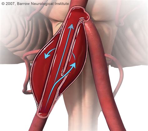 Types of Cerebral Aneurysms | Joe Niekro Foundation