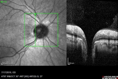 Vertical OCT Scan Through Right Optic Disc Pit - Retina Image Bank