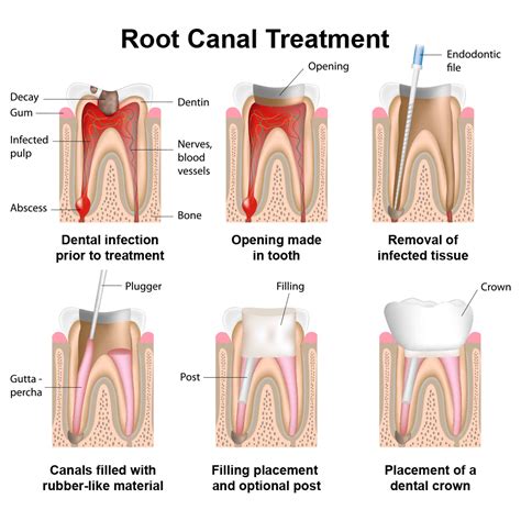 Root Canal Therapy – Little Rock, AR – Restorative Dentistry – Dr. Ray