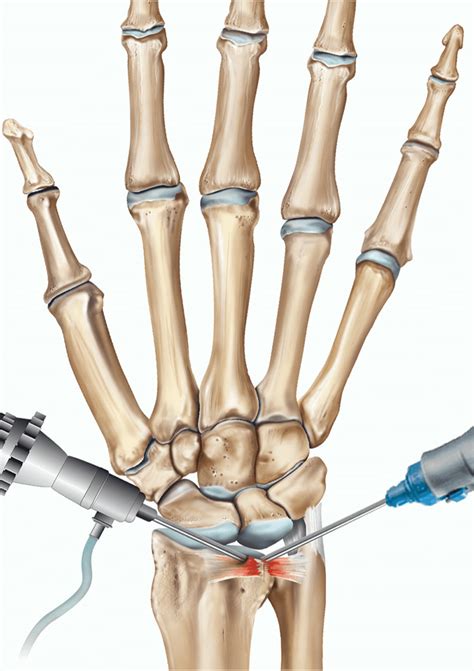 Patient Education Wrist | Wrist Surgery | FixBones Orthopaedic