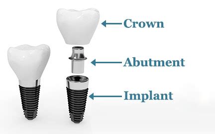 Implants - dentoamerica