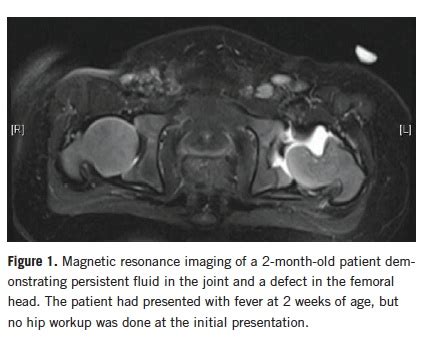 Septic Hip, or Transient Synovitis? Assessing the Diagnostic Utility of ...