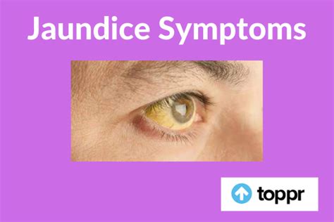 Jaundice Symptoms: Diagnosis, Causes, Treatment