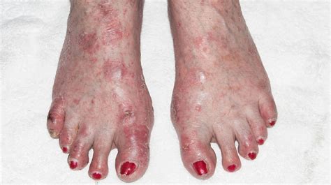 Dermatitis On Feet