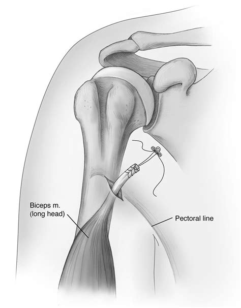 Biceps tenodesis technique, Haderer & Muller Art Medicine Journal ...