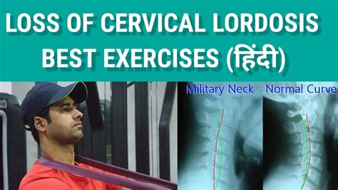 LOSS OF CERVICAL LORDOSIS EXERCISES IN HINDI | STRAIGHTENING OF ...