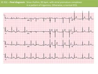 ID 352 –Sinus rhythm With premature atrial complex | PPT