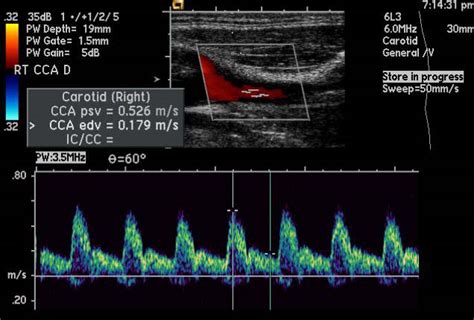 Carotid artery stenosis echocardiography or ultrasound - wikidoc
