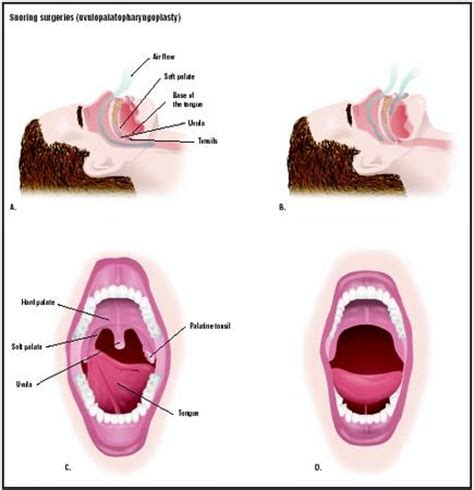 Snoring Surgery - procedure, recovery, test, blood, removal, pain, complications, adults