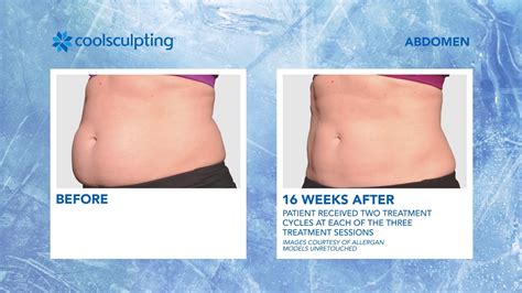 CoolSculpting Before and After - YouTube